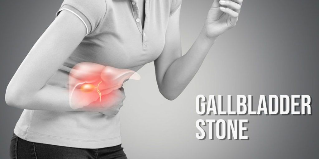 Effective Treatment Options for Gallbladder Stones